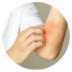 Atopowe zapalenie skóry