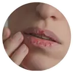 Złuszczenie lub pękanie warg