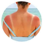 Podrażniona skóra po opalaniu